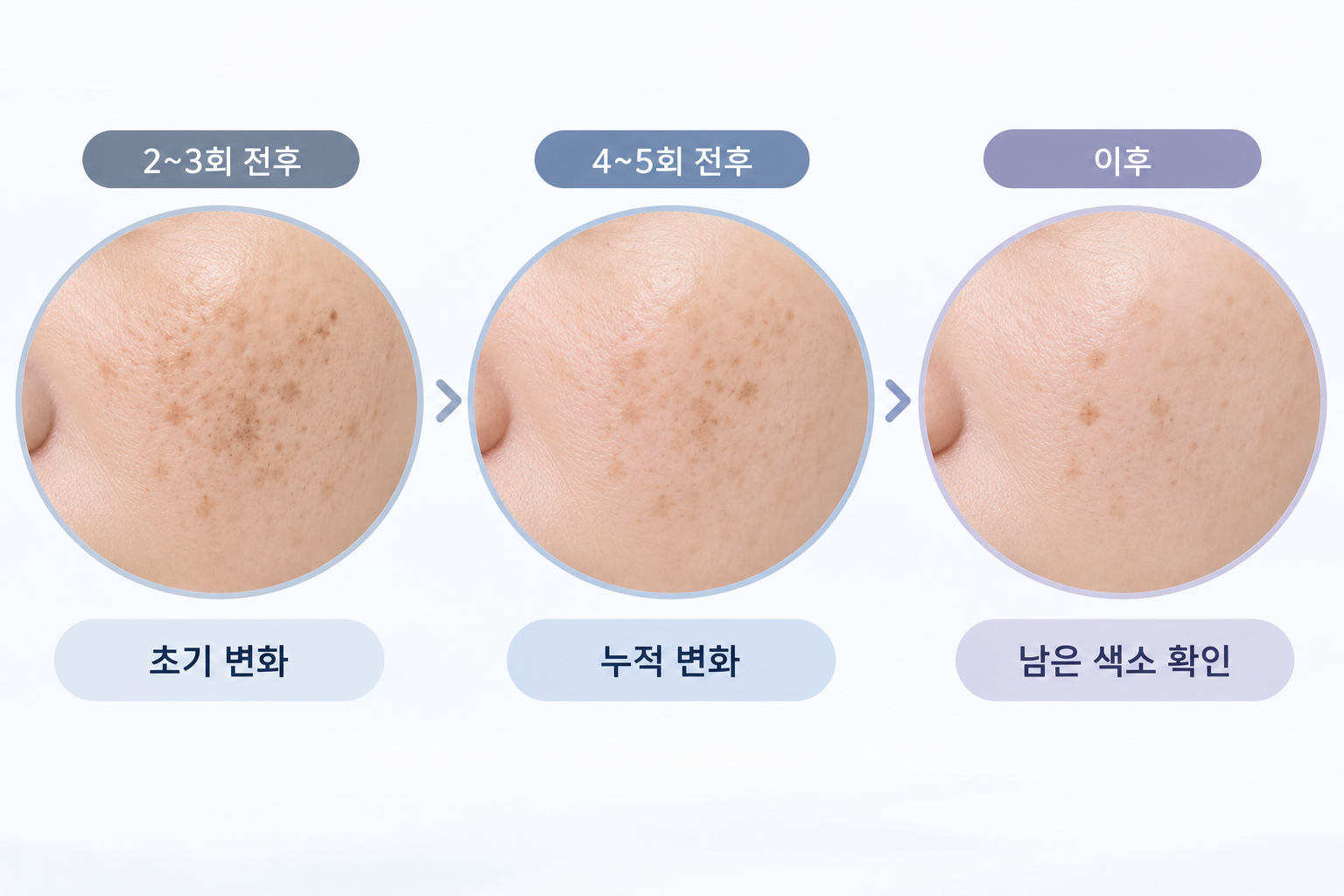 피코토닝 치료 회차에 따른 색소 변화