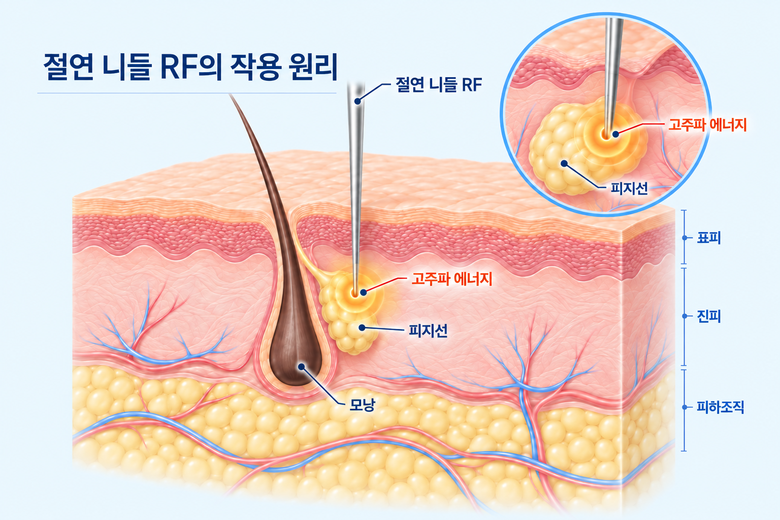 절연 니들 RF가 피지선 부근에 고주파 에너지를 전달하는 피부 단면도