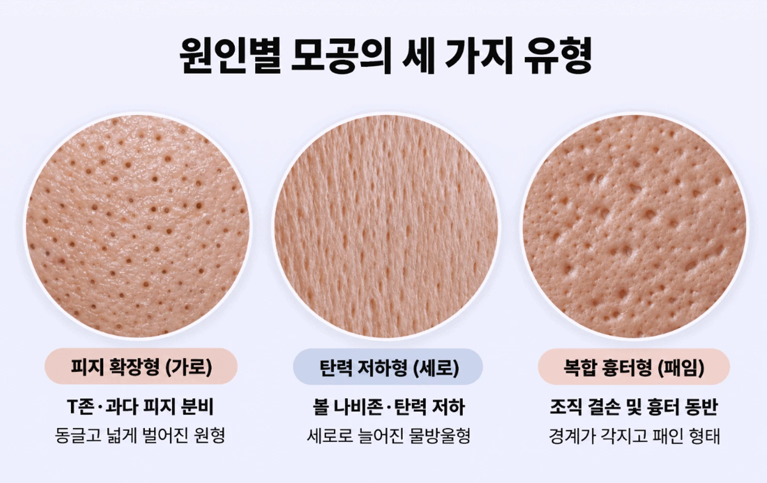 피지 과다, 탄력 저하, 조직 결손 등 원인에 따른 세 가지 모공 유형의 피부 표면 형태 비교 확대도