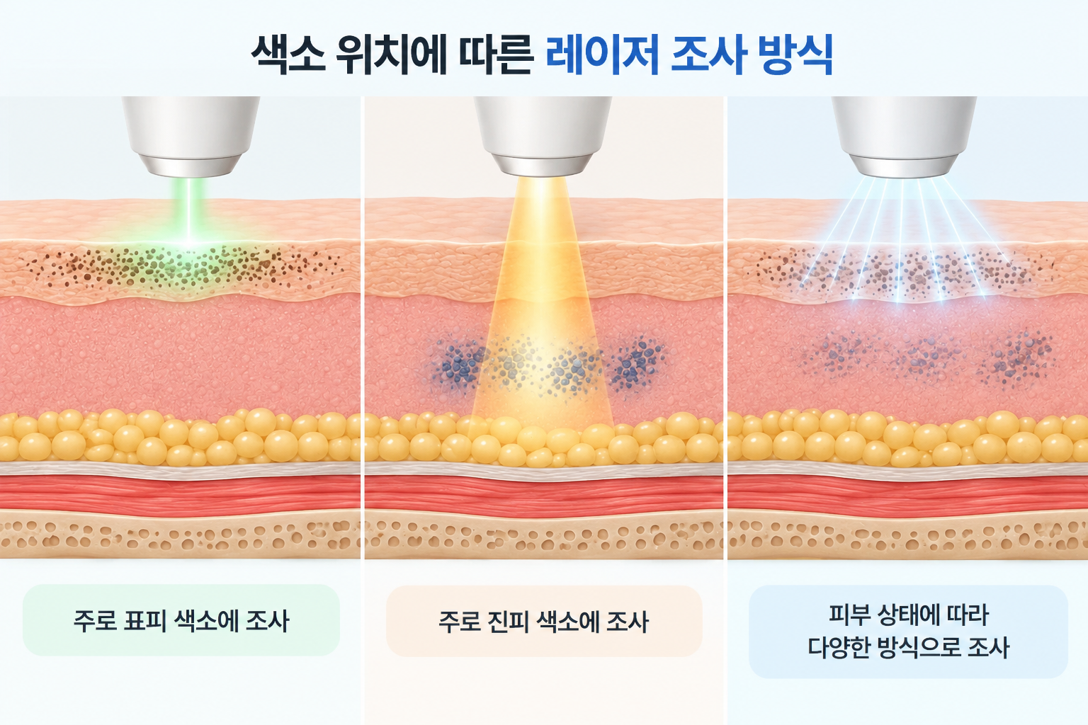 표피와 진피 색소 위치에 따른 레이저 조사 방식 비교