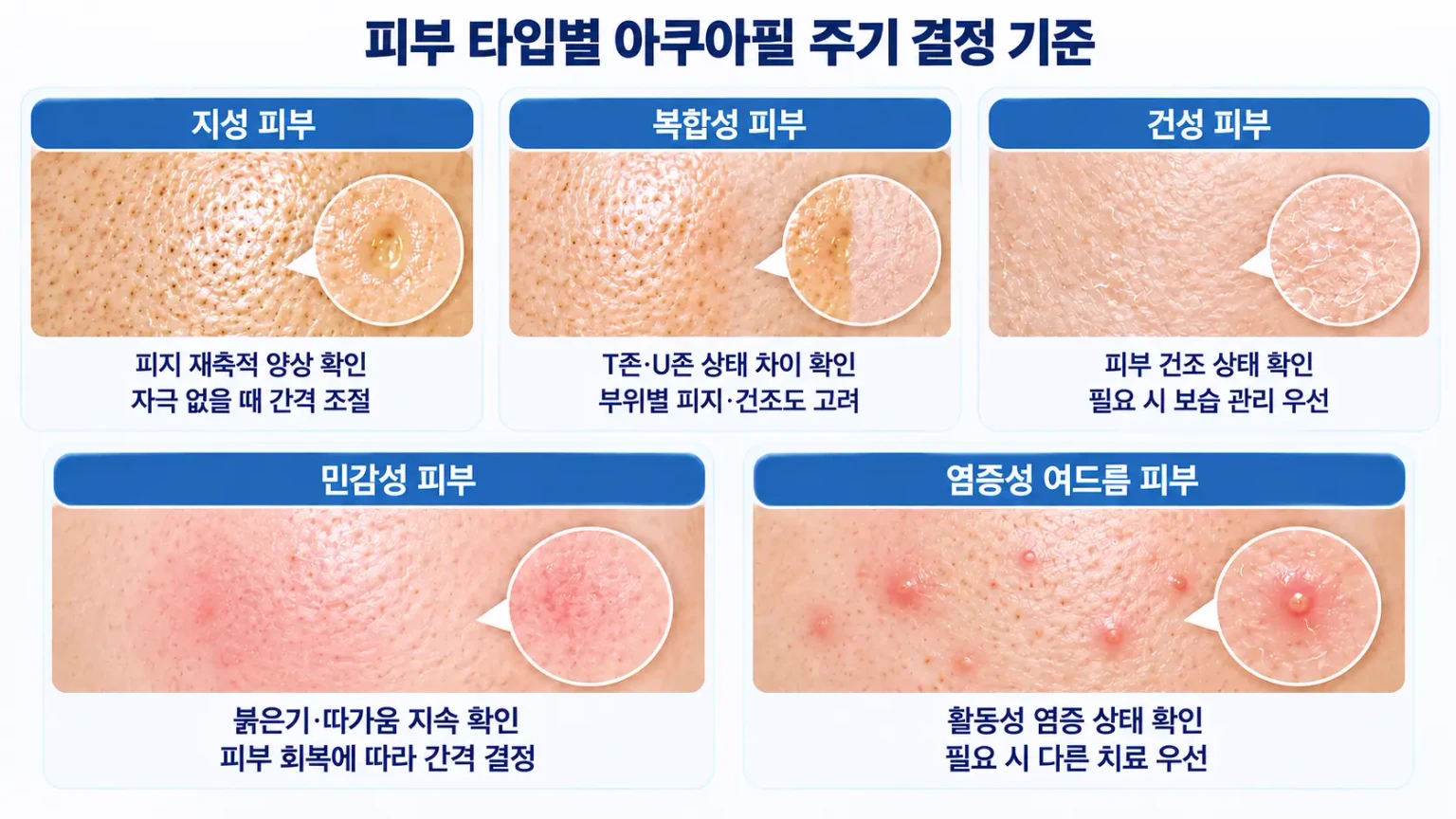 피부 타입별 아쿠아필 시술 주기와 관리 시 고려사항을 비교한 이미지