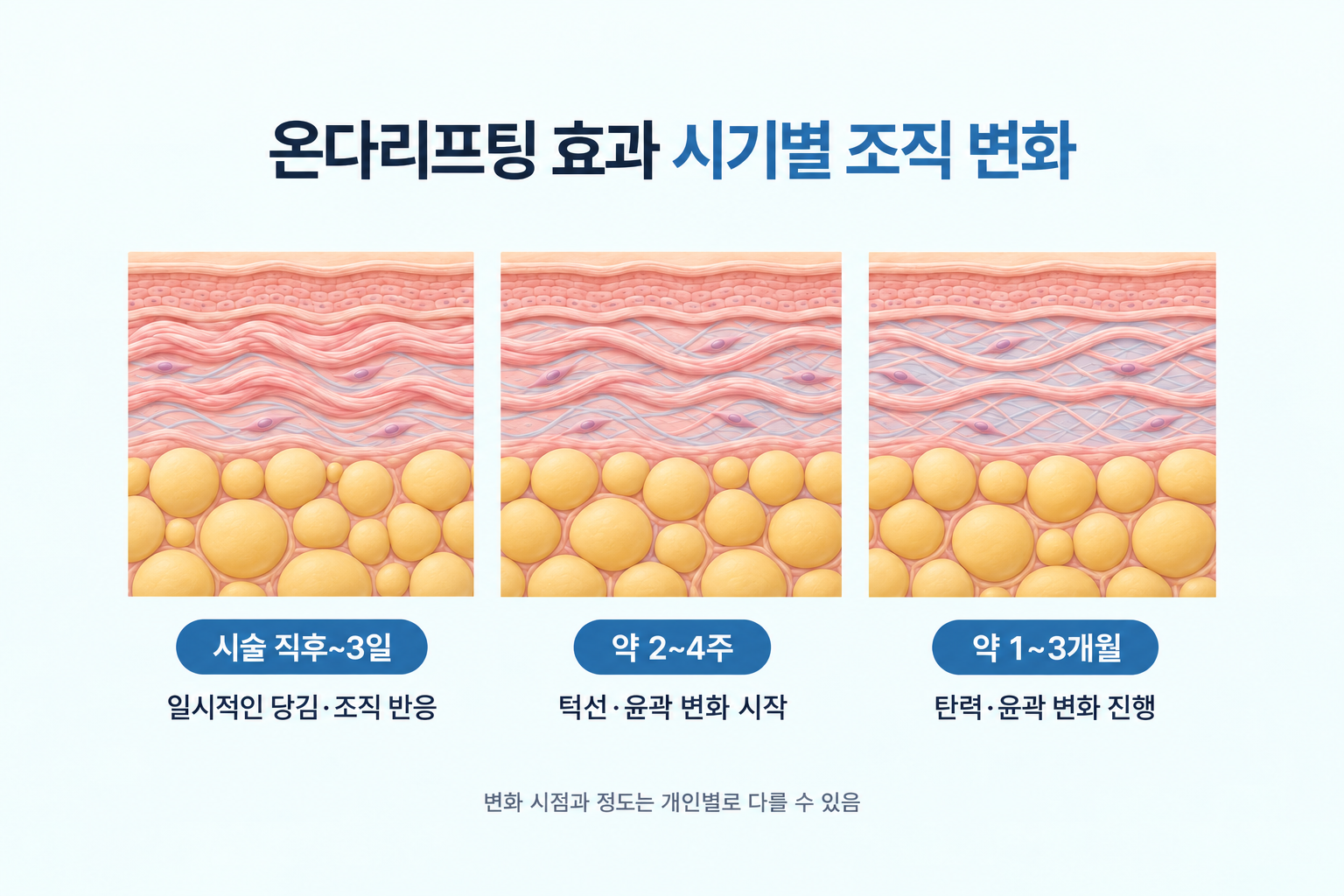 온다리프팅 시술 직후부터 3일, 2~4주, 1~3개월까지 시기별 피부 조직 변화를 나타낸 이미지