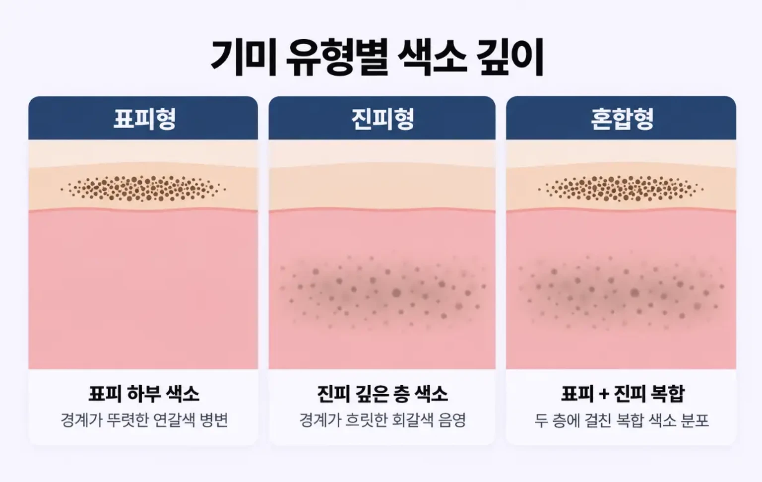표피형, 진피형, 혼합형 기미의 멜라닌 분포 깊이를 같은 배율로 비교한 피부 단면 모식도