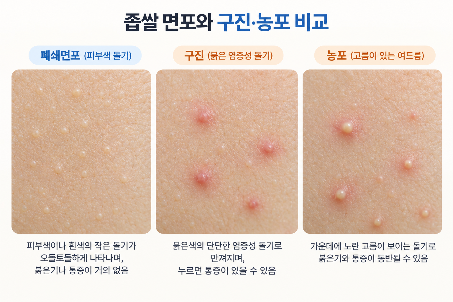좁쌀여드름-폐쇄면포-구진-농포-피부상태-비교