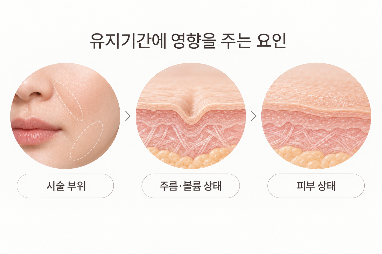 쥬비덤 필러 유지기간에 영향을 주는 시술 부위 주름 볼륨 피부 상태
