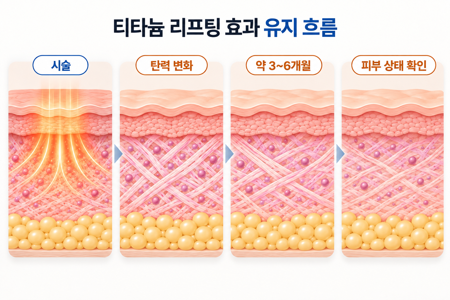 티타늄 리프팅 효과의 탄력 변화와 약 3~6개월 유지 흐름