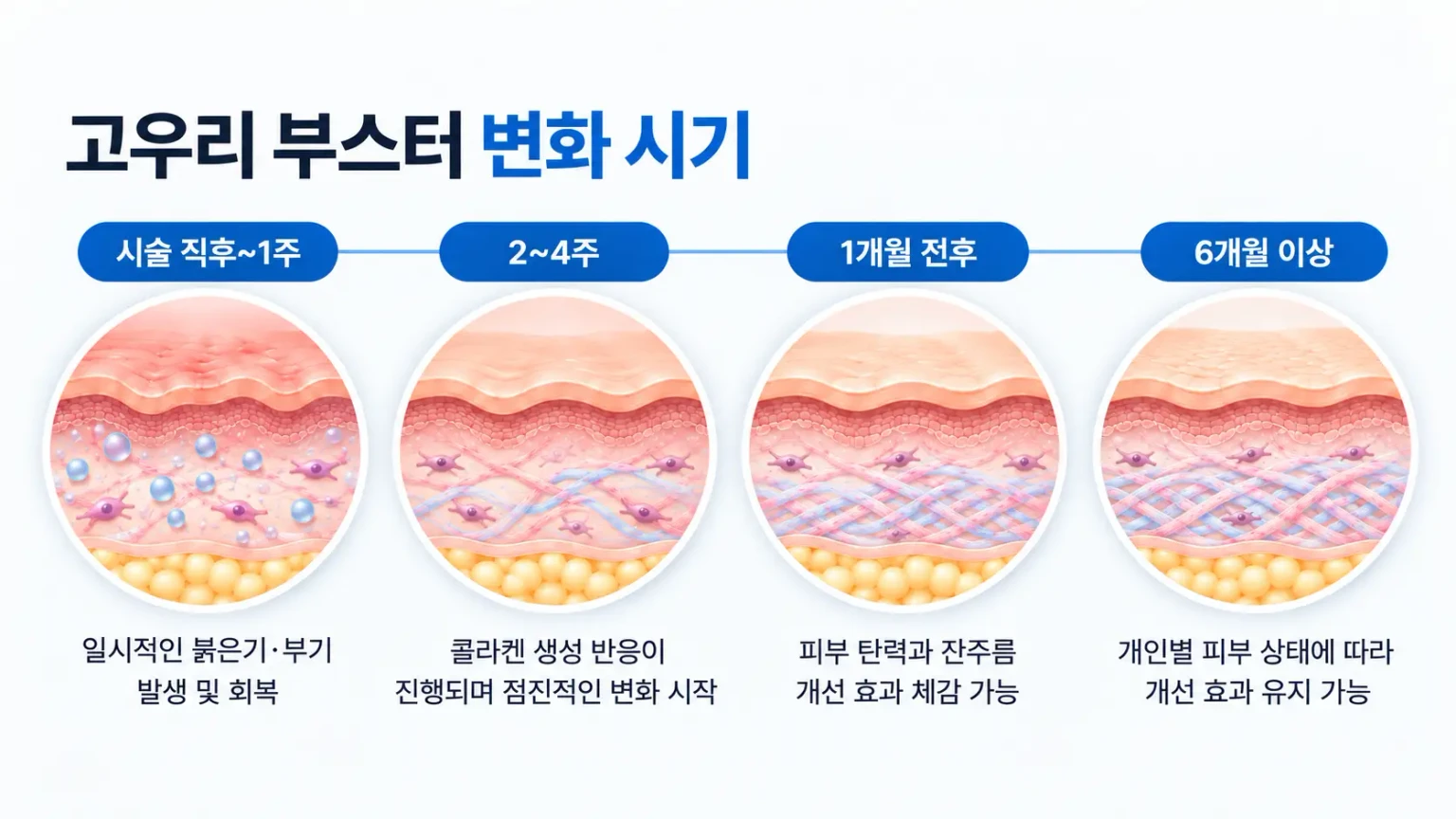 고우리 부스터 시술 직후부터 수개월 후까지 콜라겐 형성에 따른 변화 시기를 정리한 타임라인 이미지