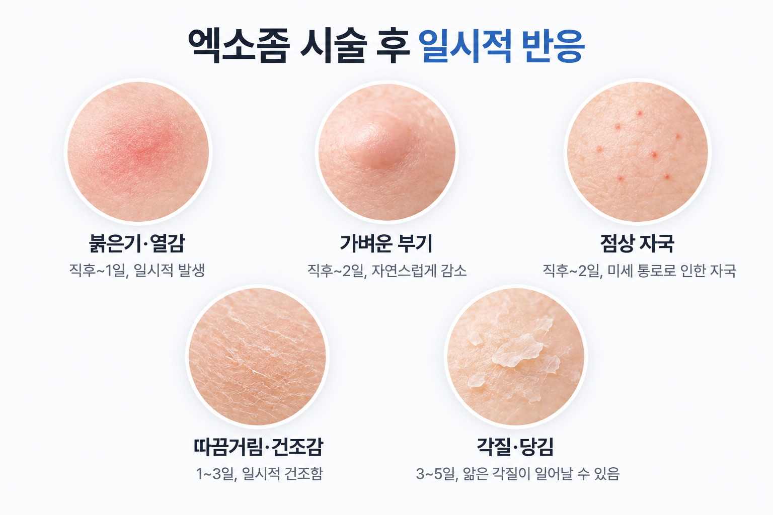 엑소좀 시술 후 나타날 수 있는 붉은기 부기 점상 자국 건조감과 각질