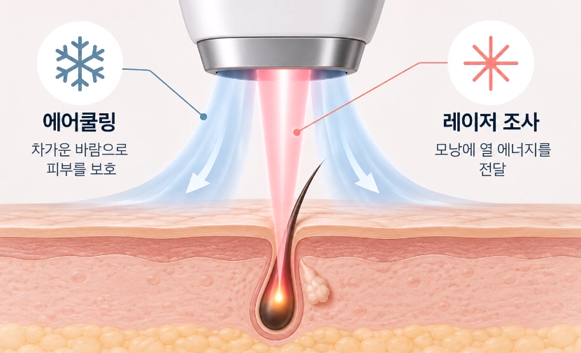레이저 조사와 에어쿨링을 이용한 아포지 플러스 인중 제모 원리