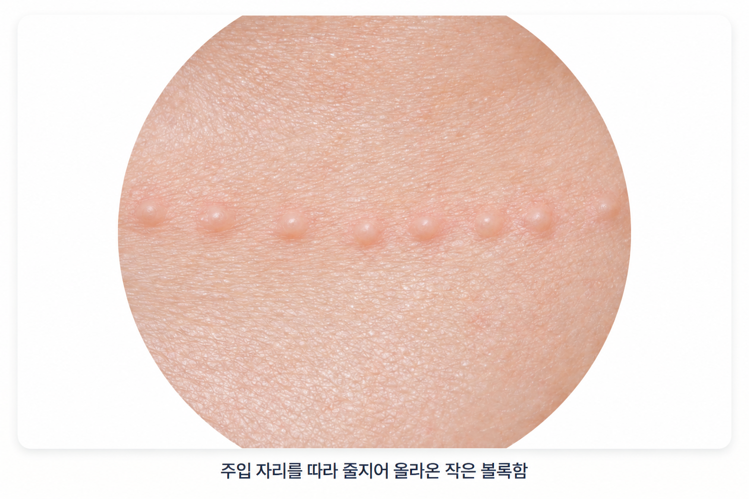 리쥬란 아이 시술 직후 눈밑 피부의 주입 자리를 따라 작게 올라온 엠보와 붉은기