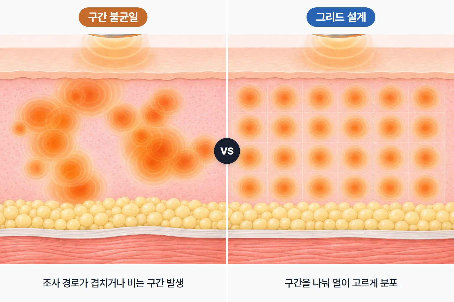에너지가 겹치거나 비는 구간과 그리드 설계로 고르게 분포한 열을 비교한 피부 표면 도식
