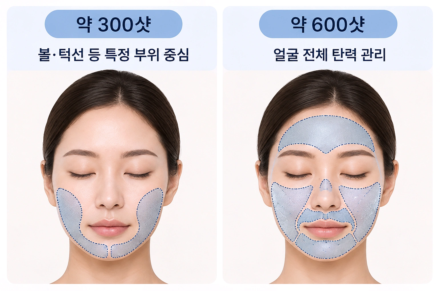 볼·턱선 등 특정 부위 중심 300샷과 얼굴 전체 600샷의 볼뉴머 고주파 조사 범위 차이를 비교한 이미지