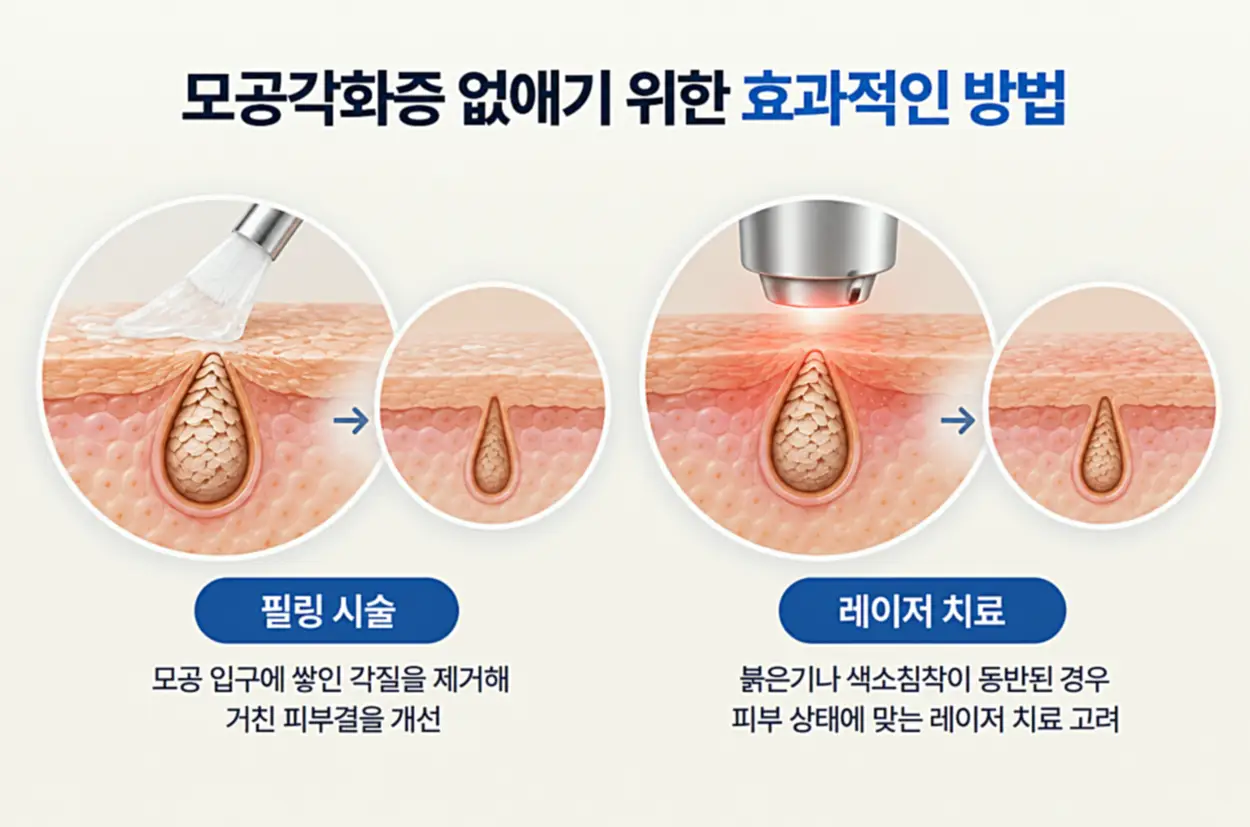 모공각화증 개선을 위한 필링 시술과 레이저 치료 방법을 피부 단면도로 비교한 인포그래픽.