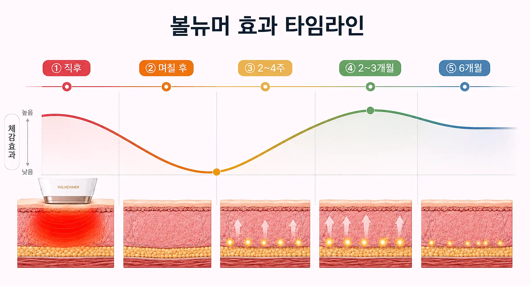 볼뉴머 효과 시점 타임라인 - 리프팅 시술 직후부터 2~3개월 최대 효과까지