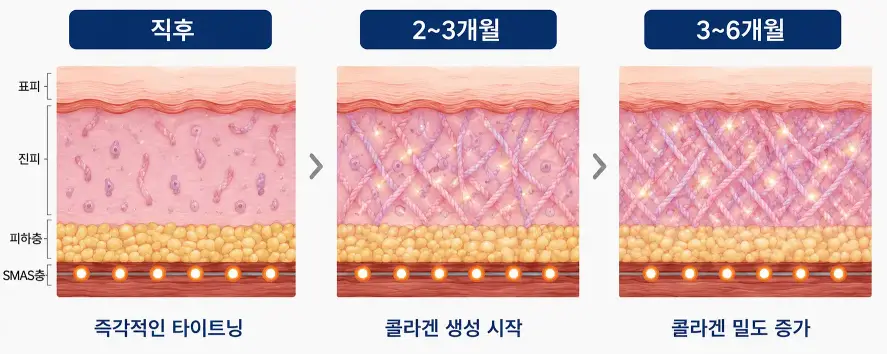 울쎄라 리프팅 시기별 콜라겐 생성과 탄력 변화 과정