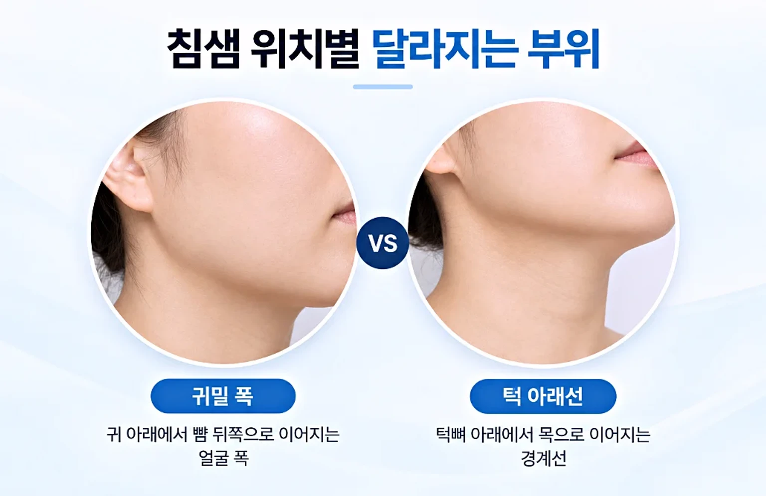 귀밑 폭과 턱 아랫선 부위를 각각 크롭해 두 컷으로 비교한 침샘보톡스 변화 범위 사진
