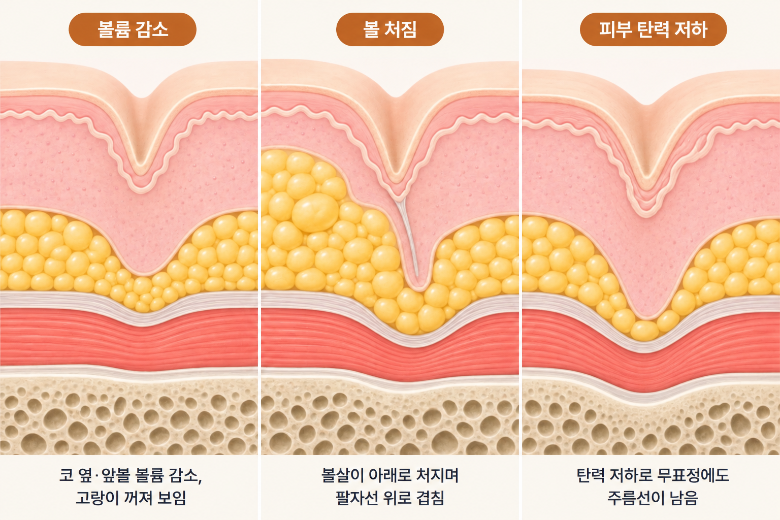 팔자주름 볼륨 부족형의 코 옆 꺼짐, 처짐형의 팔자선 위 볼살 겹침, 혼합형의 꺼짐과 처짐 동반 특징