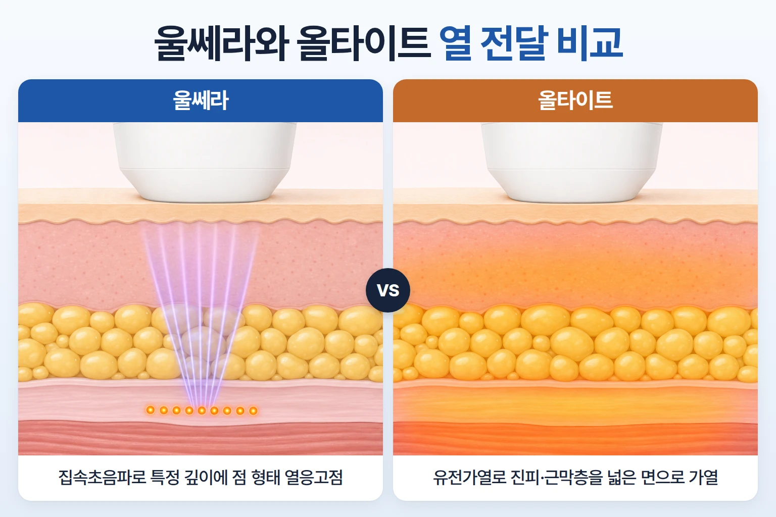 울쎄라의 점 형태 열응고점과 올타이트의 넓은 층 가열을 같은 피부 단면에서 비교한 일러스트