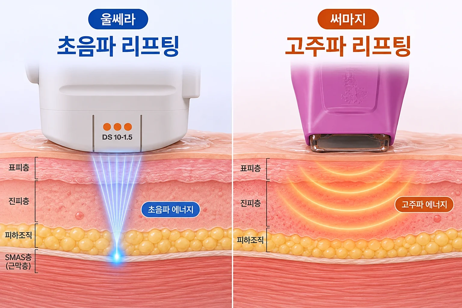 집속 초음파가 근막층 초점에, 고주파 열이 진피층에 넓게 퍼지는 깊이를 나타낸 피부 단면 일러스트