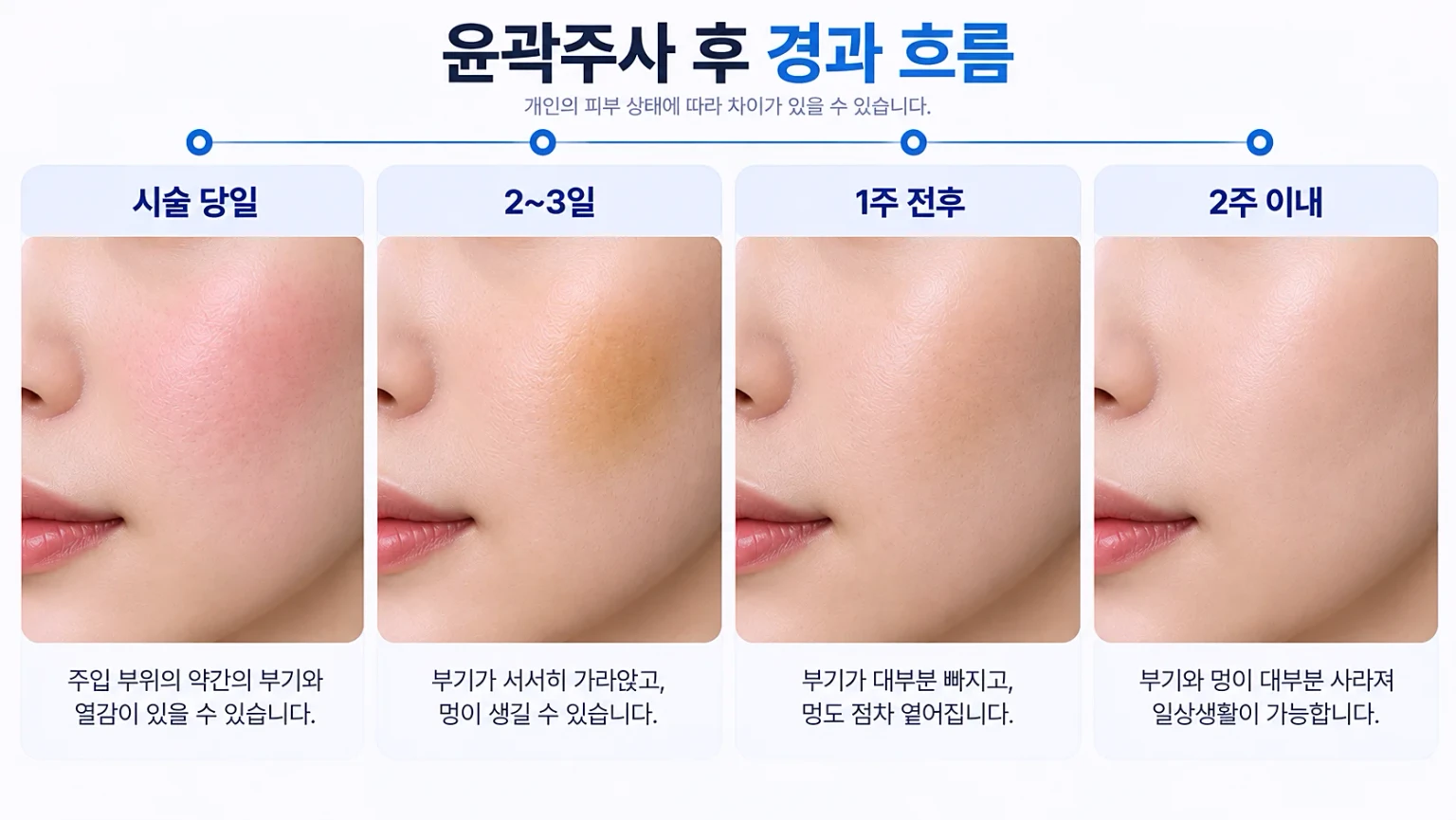윤곽주사 시술 당일부터 2주 이내까지 부기와 멍, 활동 제한 시점을 정리한 경과 흐름