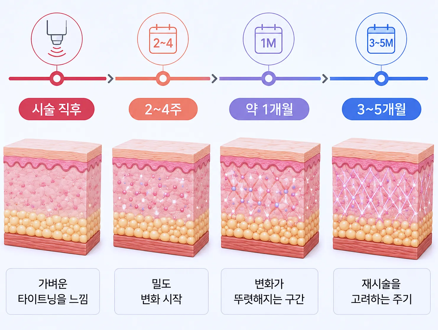 볼링크 효과 시점 타임라인 - 시술 직후부터 재시술 주기까지