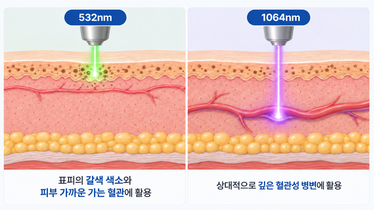 더마V 532nm 파장이 표피의 갈색 색소와 얕은 혈관에, 1064nm 파장이 상대적으로 깊은 혈관성 병변에 작용하는 피부 단면 비교