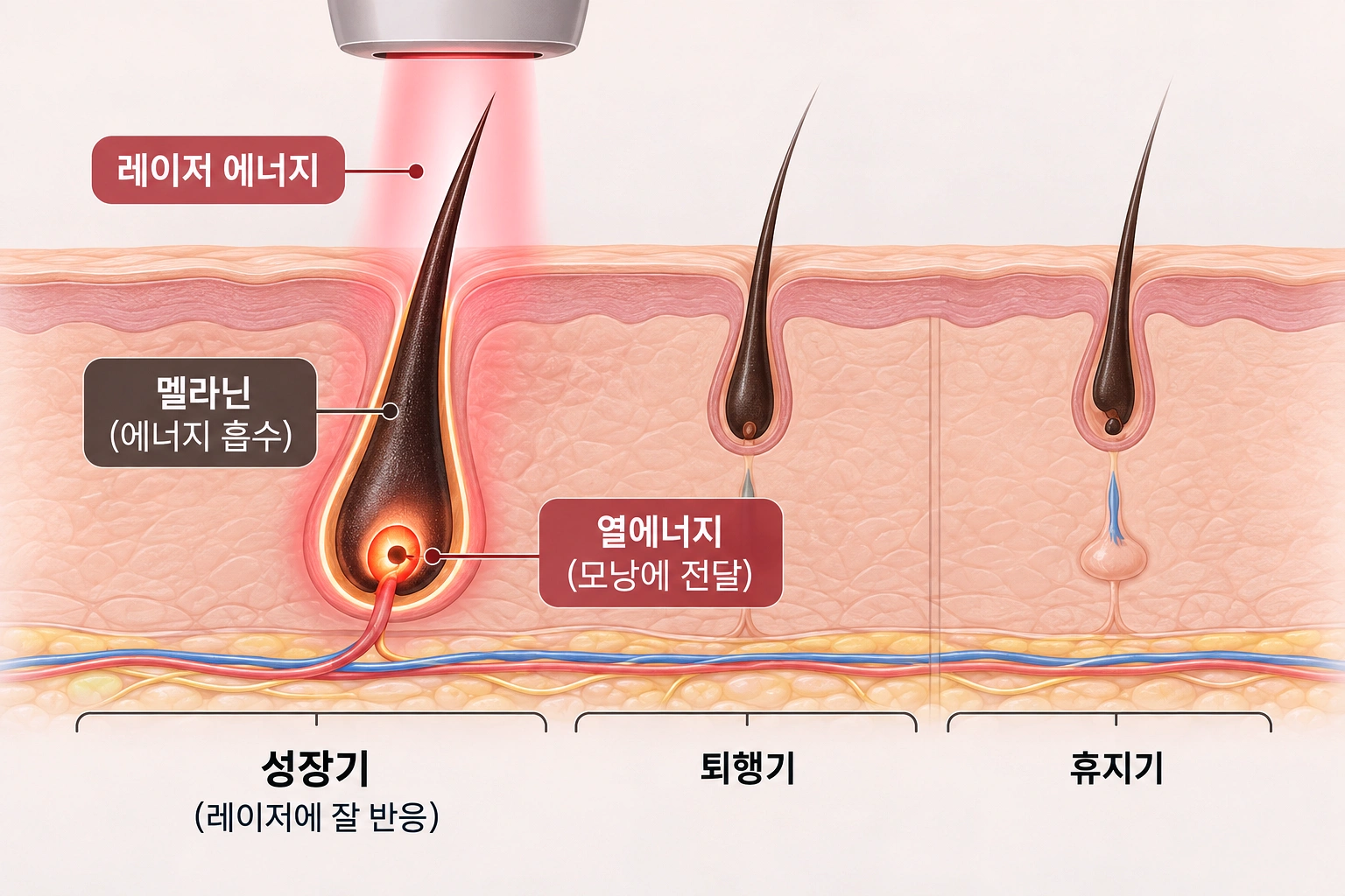 여자 겨드랑이 제모 원리와 성장기·퇴행기·휴지기를 비교한 단면도