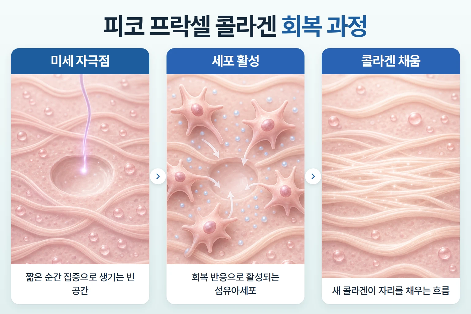 진피 미세 공간 형성과 섬유아세포 활성, 콜라겐 채움 단계를 나타낸 작용 원리 개념도