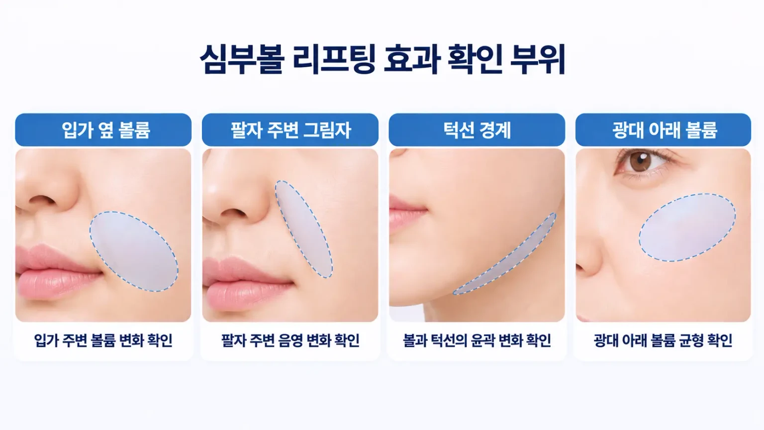 심부볼 리프팅 효과를 확인하는 입가 옆 볼륨, 팔자 주변 그림자, 턱선 경계, 광대 아래 볼륨 비교 이미지