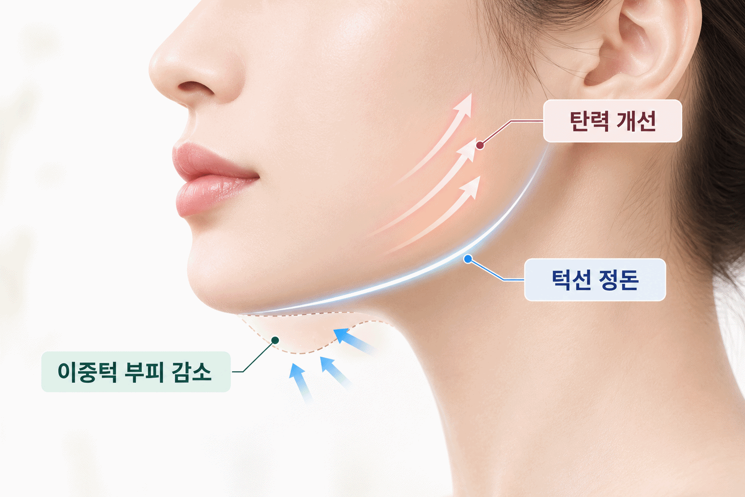 이중턱 부피 감소와 피부 탄력 개선, 턱선 정돈을 보여주는 턱 리프팅 효과