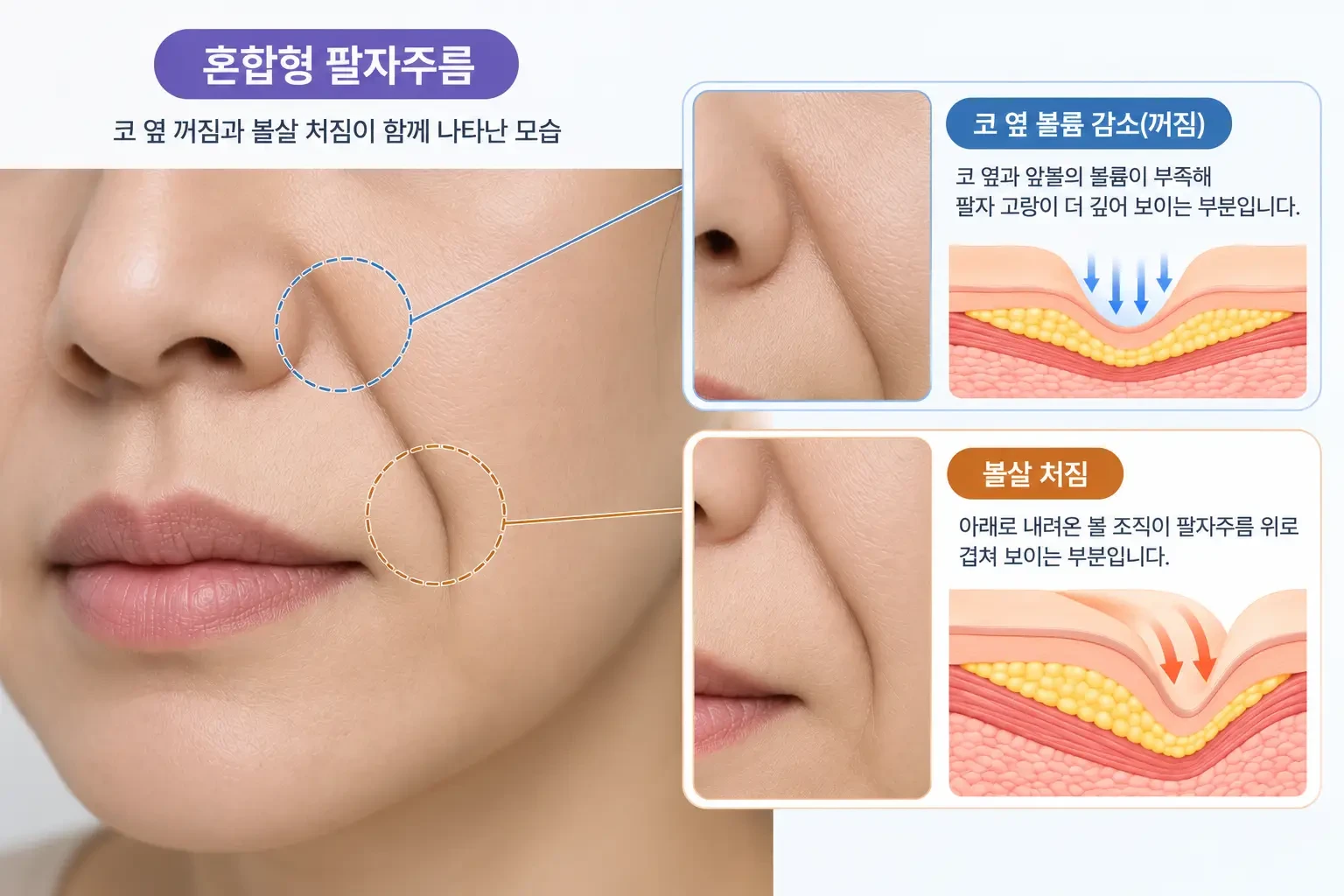 혼합형 팔자주름의 원인인 코 옆 볼륨 부족과 볼살 처짐을 피부 단면으로 설명한 이미지