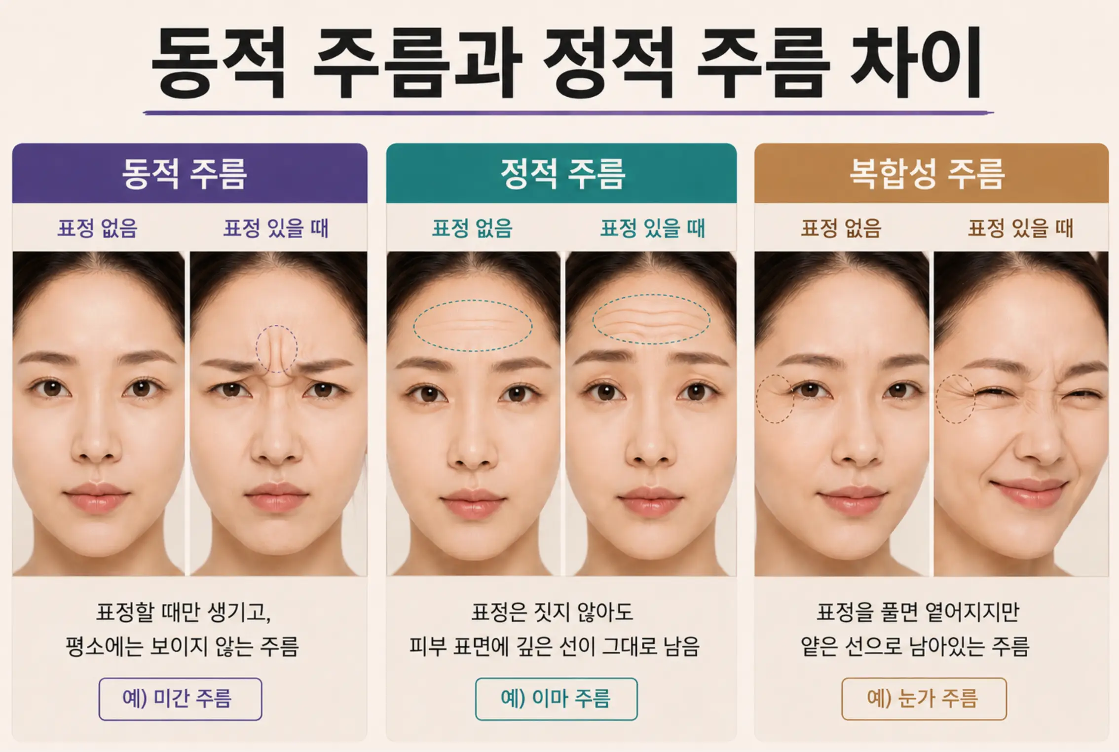 표정 유무에 따른 동적 주름 정적 주름 복합성 주름 구분법 설명