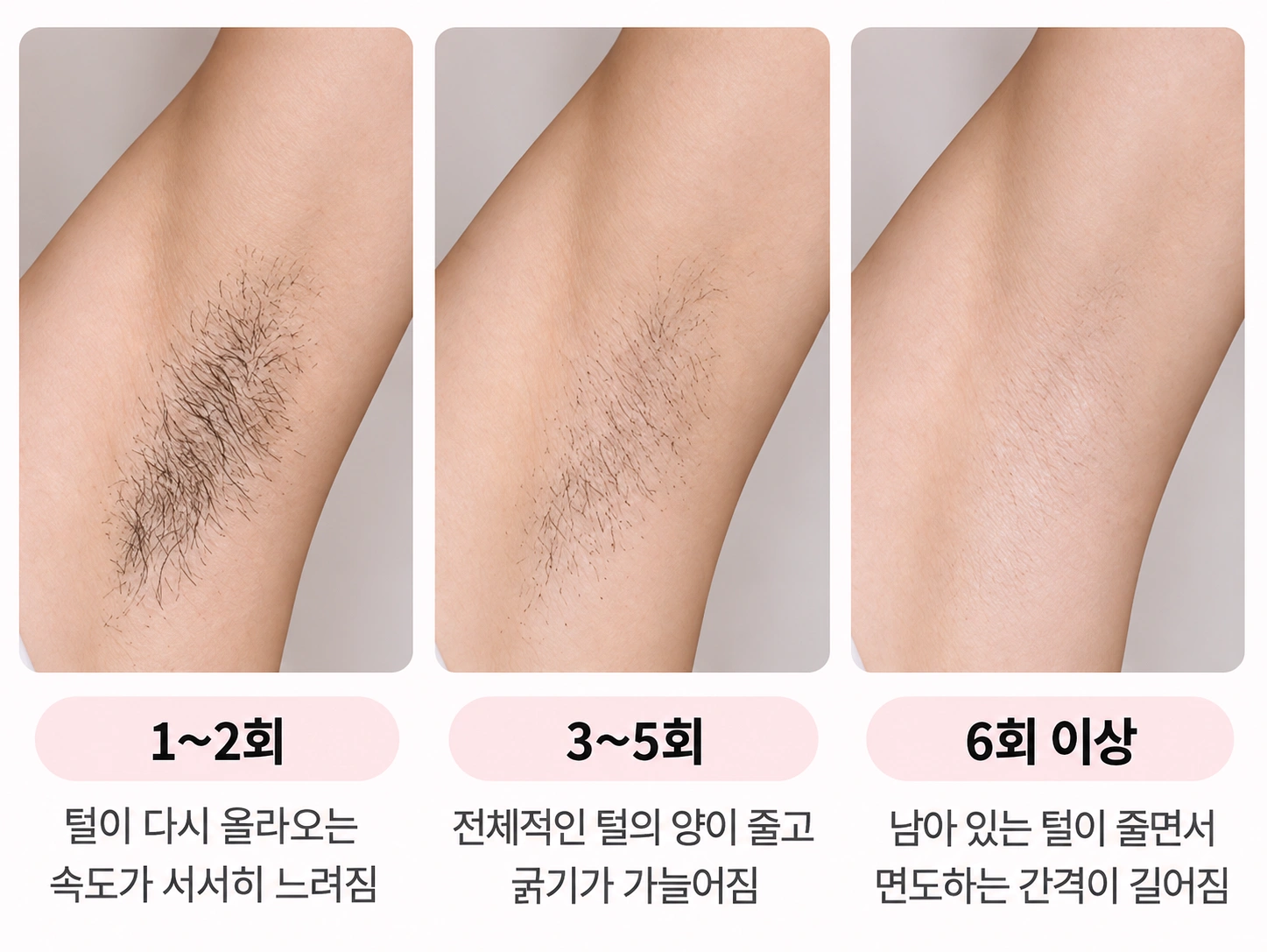 여자 겨드랑이 레이저 제모 횟수에 따라 털의 양과 굵기가 점차 줄어드는 변화를 비교한 이미지