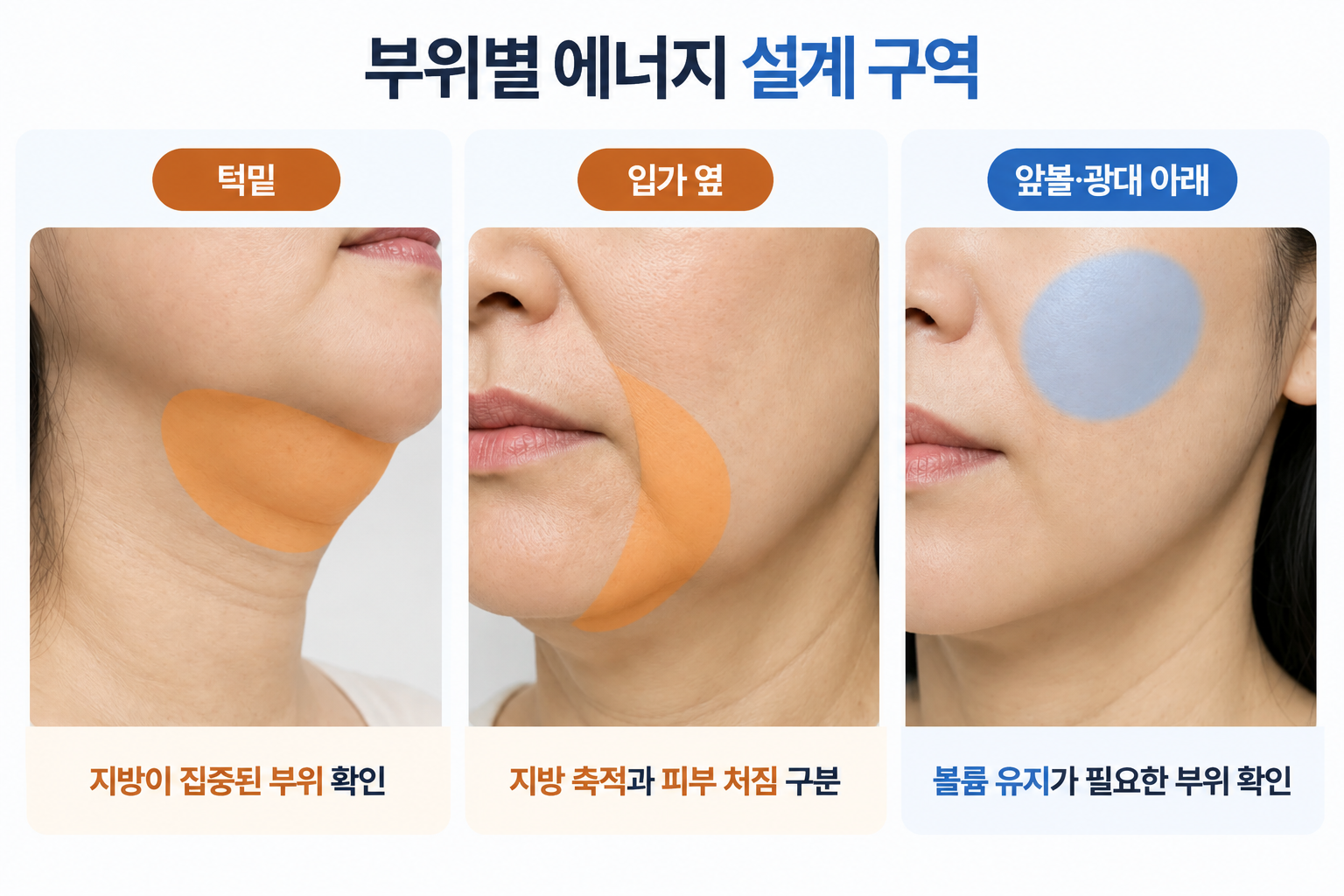 온다리프팅 시술 시 턱밑 지방 집중 부위, 입가 옆 지방과 피부 처짐 구분, 앞볼과 광대 아래 볼륨 유지 구역