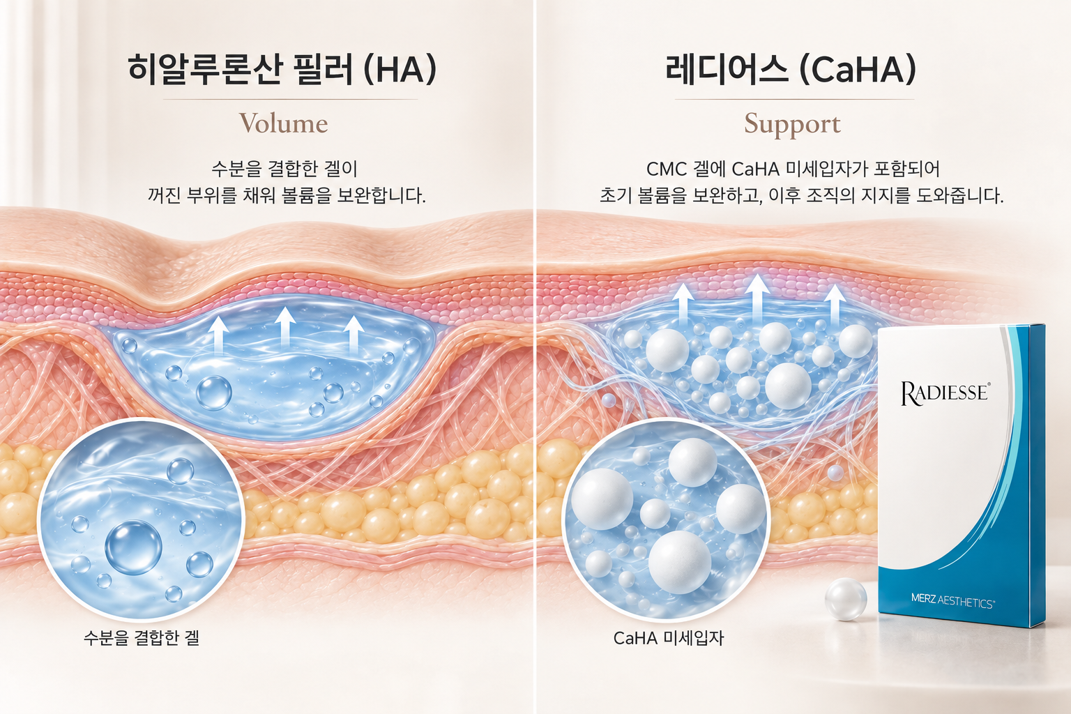 히알루론산 필러와 레디어스 CaHA 작용 원리 비교