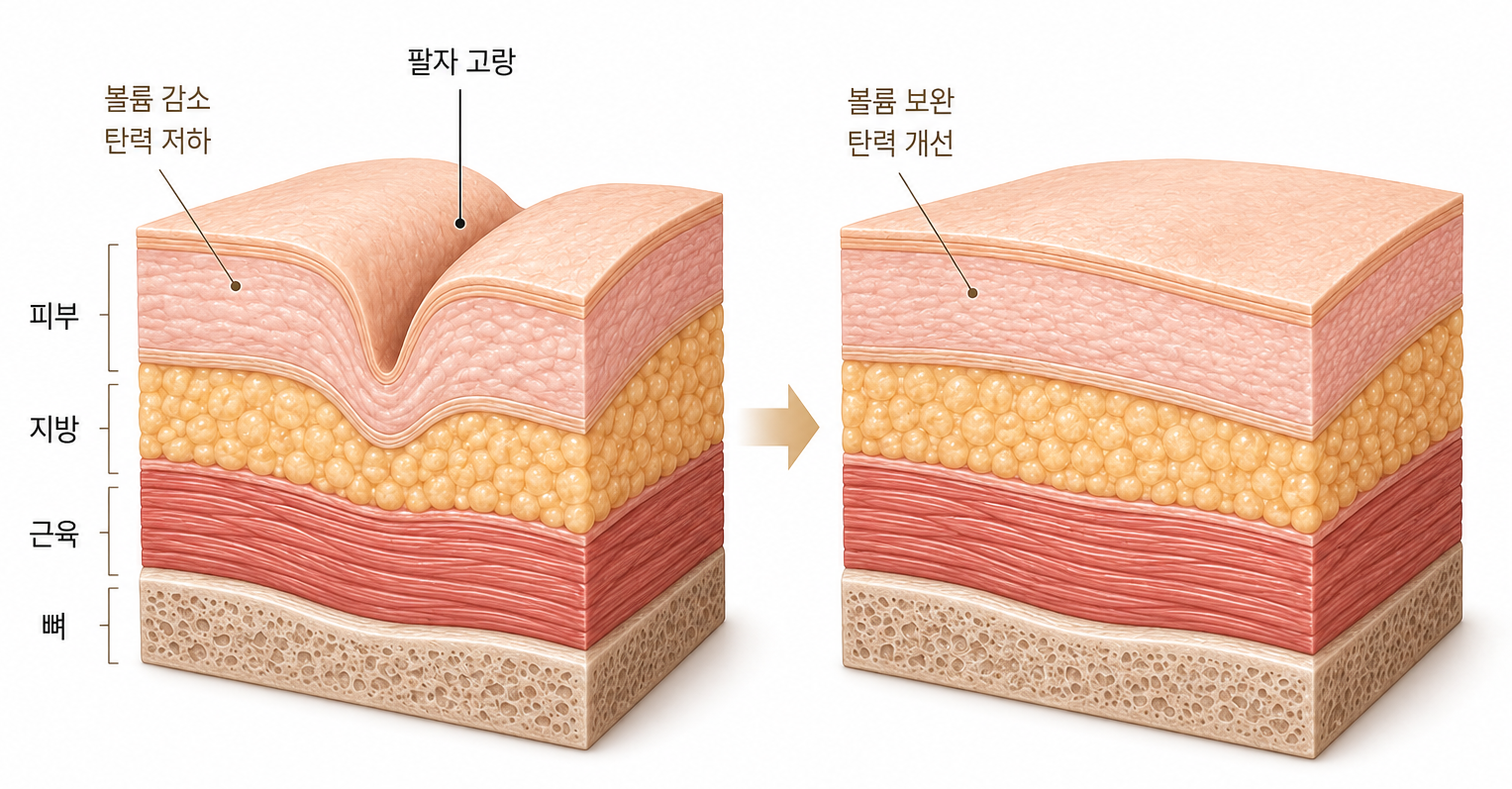 팔자 고랑의 볼륨 감소와 탄력 저하 및 개선 후 조직 변화 비교