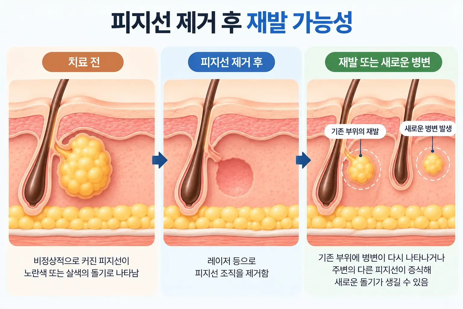피지선 제거 후 기존 부위의 재발과 주변 피지선 증식증의 새로운 병변 발생을 비교한 피부 단면도