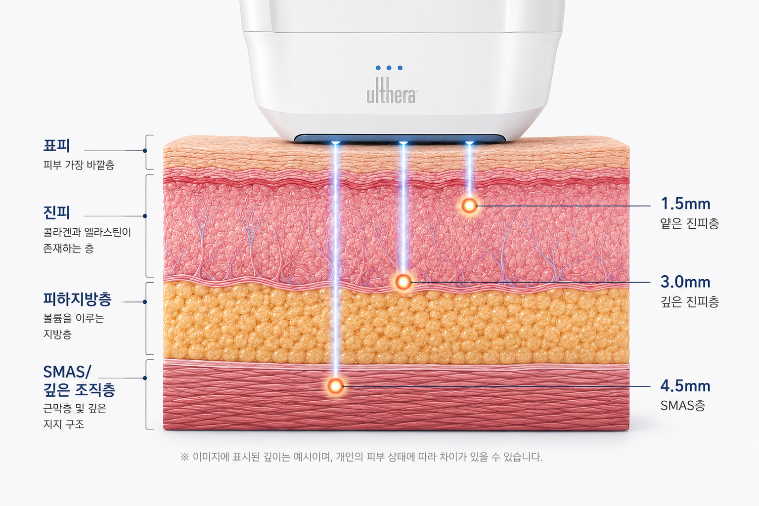 울쎄라 리프팅 1.5mm·3.0mm·4.5mm 초음파 전달 깊이와 표피·진피·피하지방층·SMAS 구조