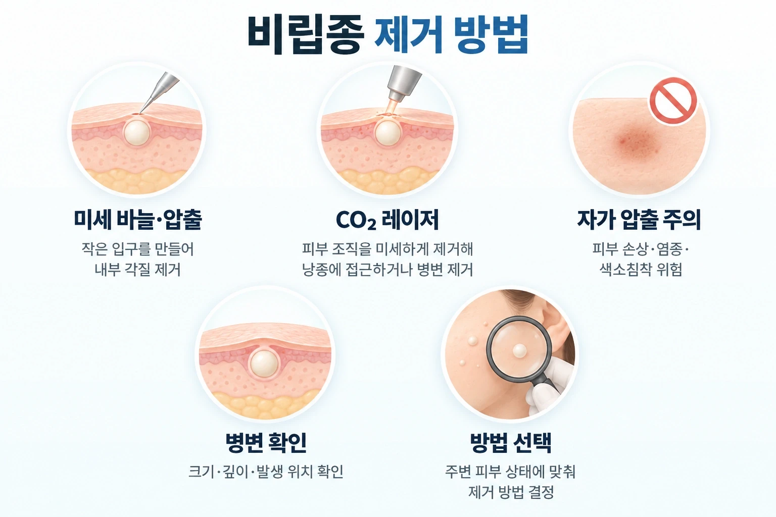 비립종 제거 시 미세 바늘 압출과 CO₂ 레이저를 적용하는 피부 단면, 자가 압출 위험 및 병변별 제거 방법 선택 기준