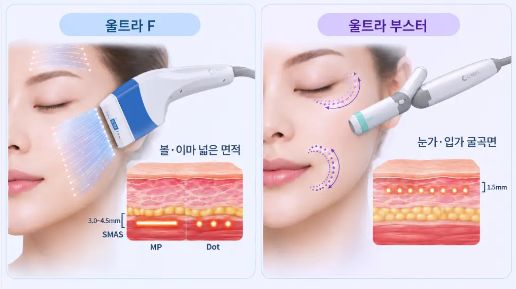 슈링크 유니버스 울트라 F와 울트라 부스터 핸드피스 비교: 볼·이마 SMAS층 3.0~4.5mm MP·Dot 조사 및 눈가·입가 1.5mm 원형 무빙