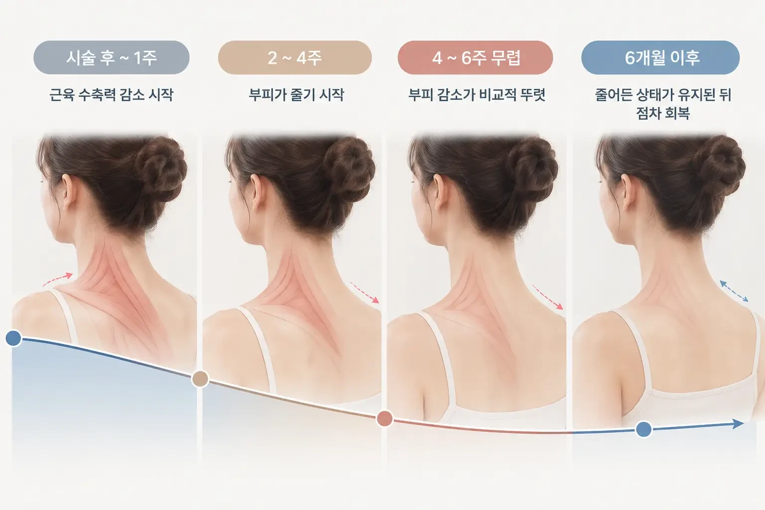 승모근보톡스 후 수일, 2~4주, 4~6주, 이후 수개월의 근육 상태 변화를 시기별로 정리한 흐름