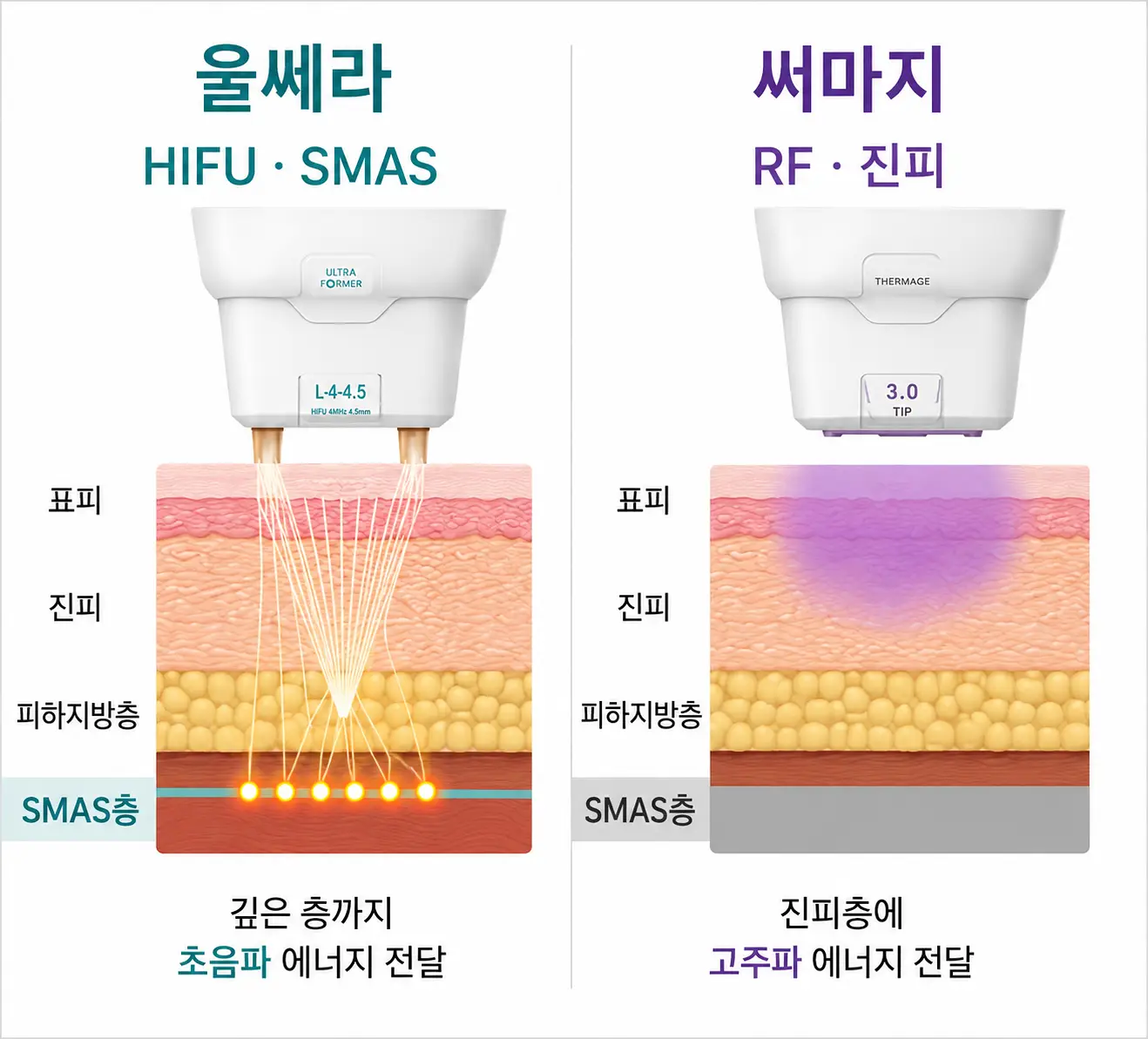 울쎄라 리프팅과 써마지의 피부층별 작용 차이