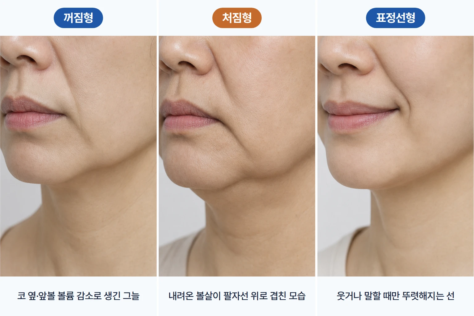 코 옆 꺼짐형, 볼살 처짐형, 웃을 때 생기는 표정선형 팔자주름을 나란히 비교한 하관 크롭 사진