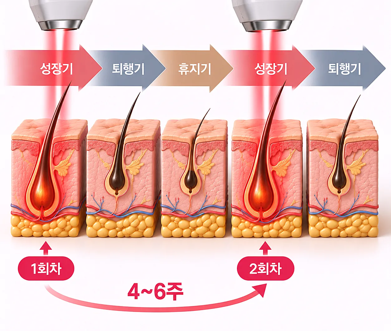 모발 성장 주기와 레이저 제모 간격의 관계