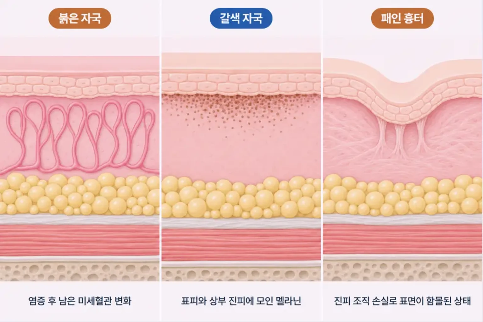 여드름 붉은 자국, 갈색 색소침착, 패인 흉터의 피부 단면 차이를 비교한 모식도