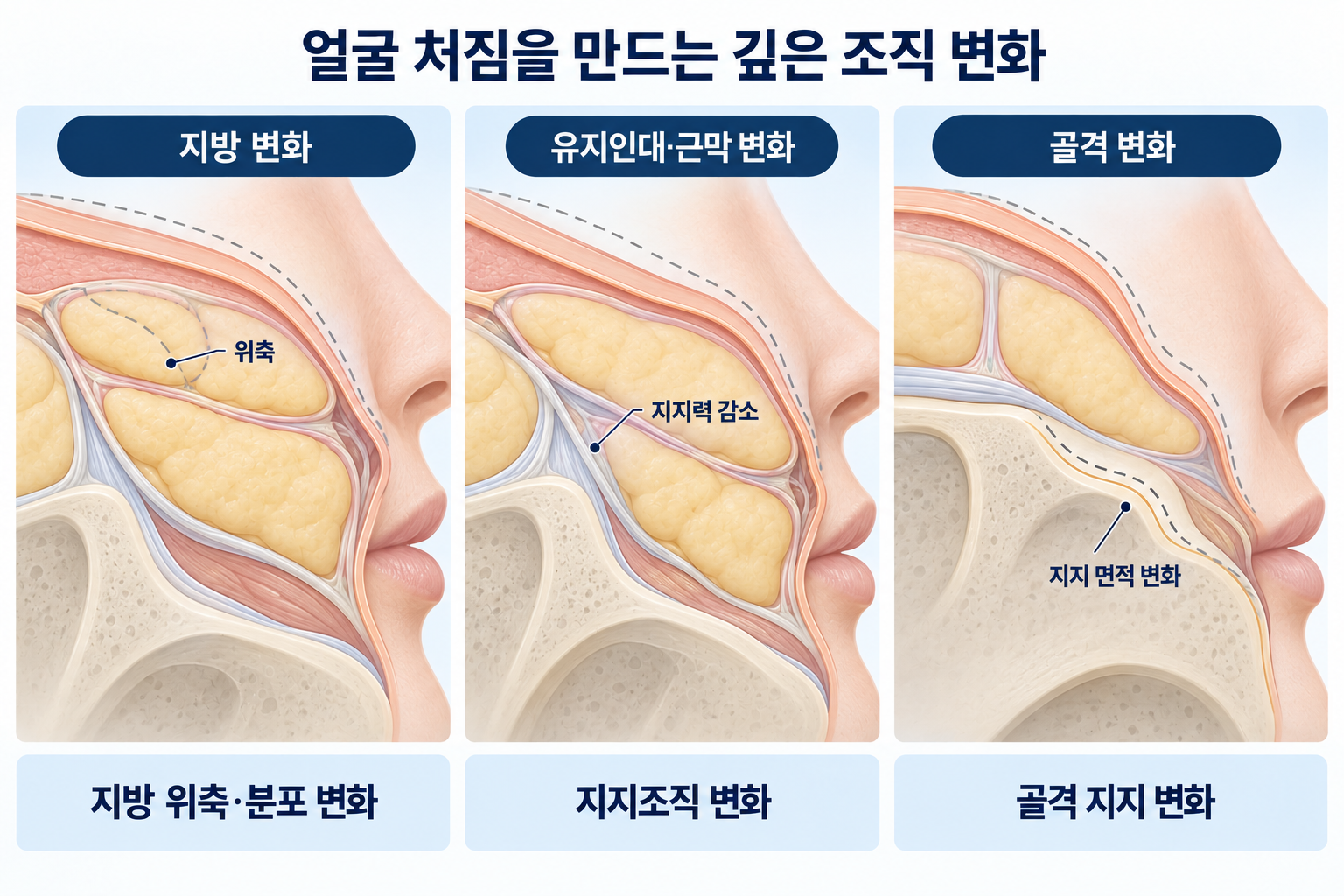 얼굴 처짐을 유발하는 지방 위축과 분포 변화, 유지인대 및 근막의 지지력 감소, 골격 변화를 비교한 피부 단면도