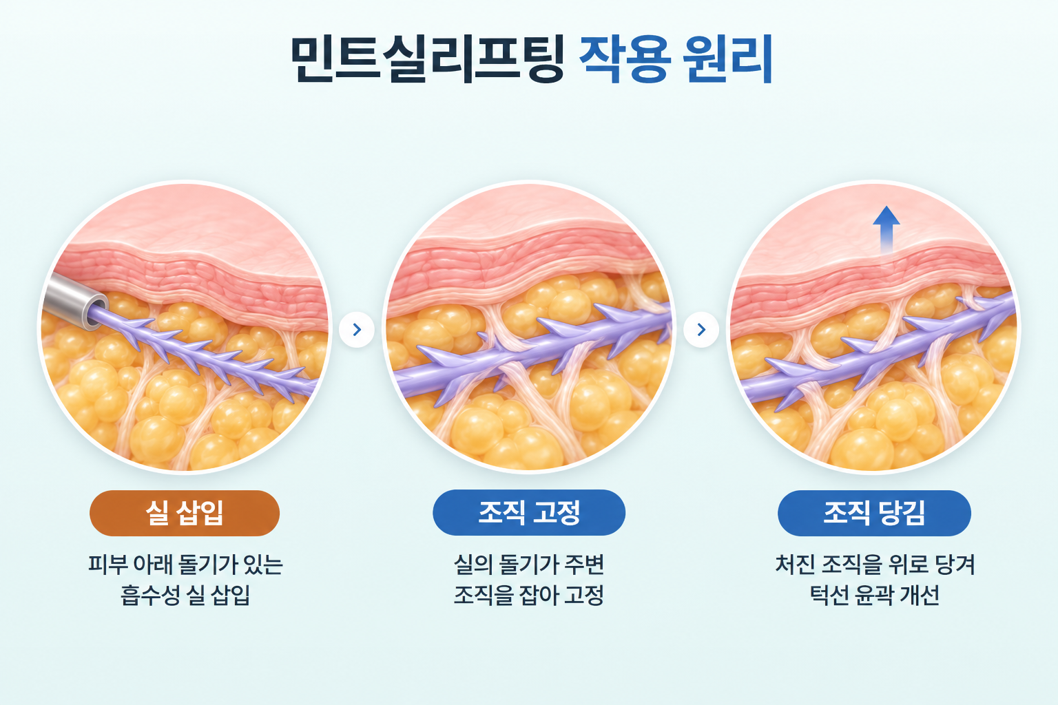 민트실리프팅의 돌기가 있는 흡수성 실 삽입, 피부 아래 조직 고정, 처진 조직을 위로 당겨 턱선 윤곽을 개선하는 과정