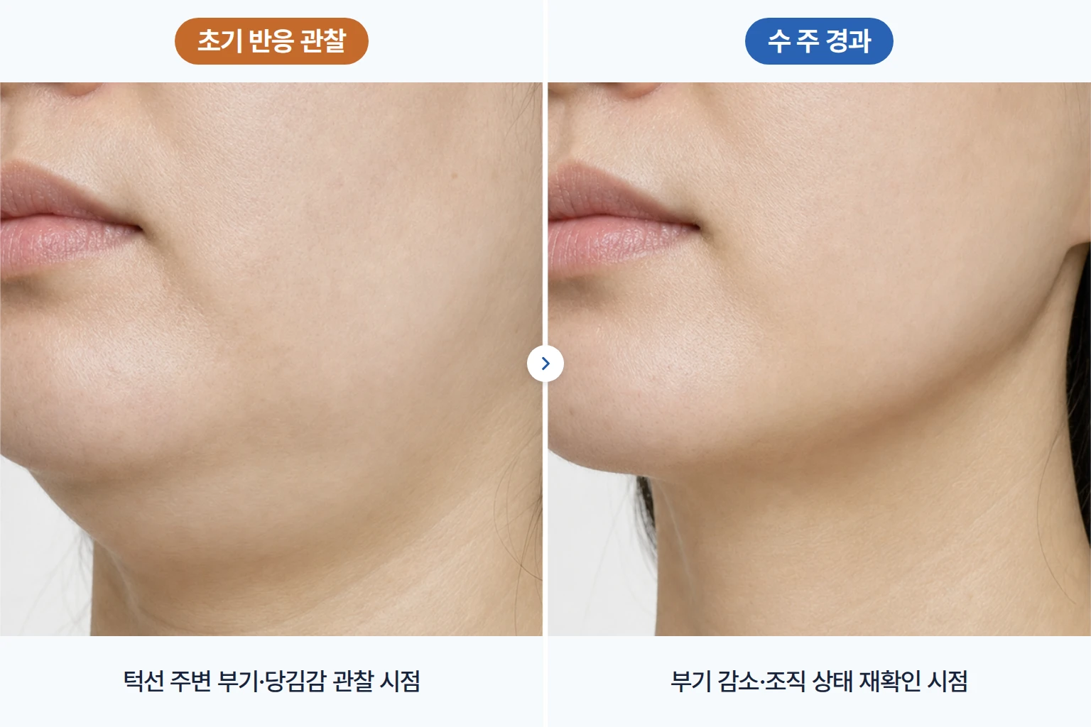 실리프팅 초기 부기와 경과 관찰 부위