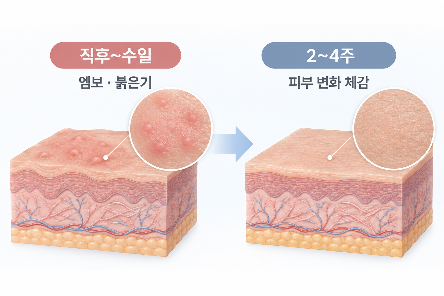 리쥬란 힐러 시술 직후 엠보와 붉은기 반응부터 2~4주 후 피부 변화 체감 시기 비교
