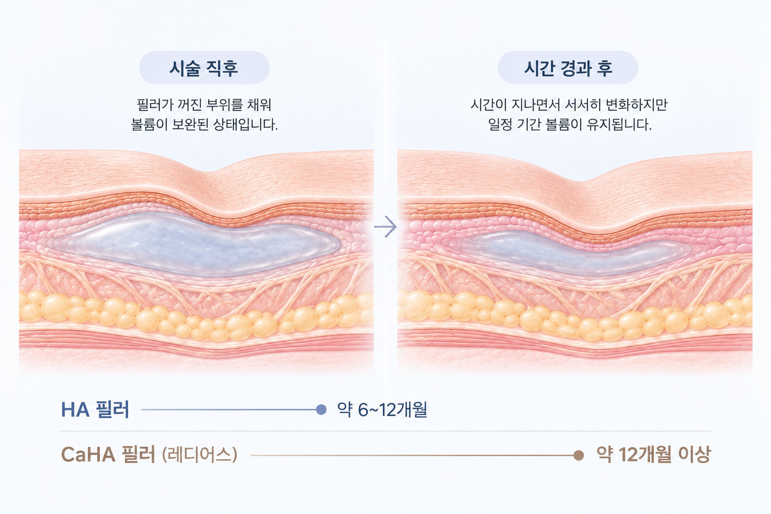 히알루론산 필러와 레디어스 팔자 주름 필러 유지기간 비교